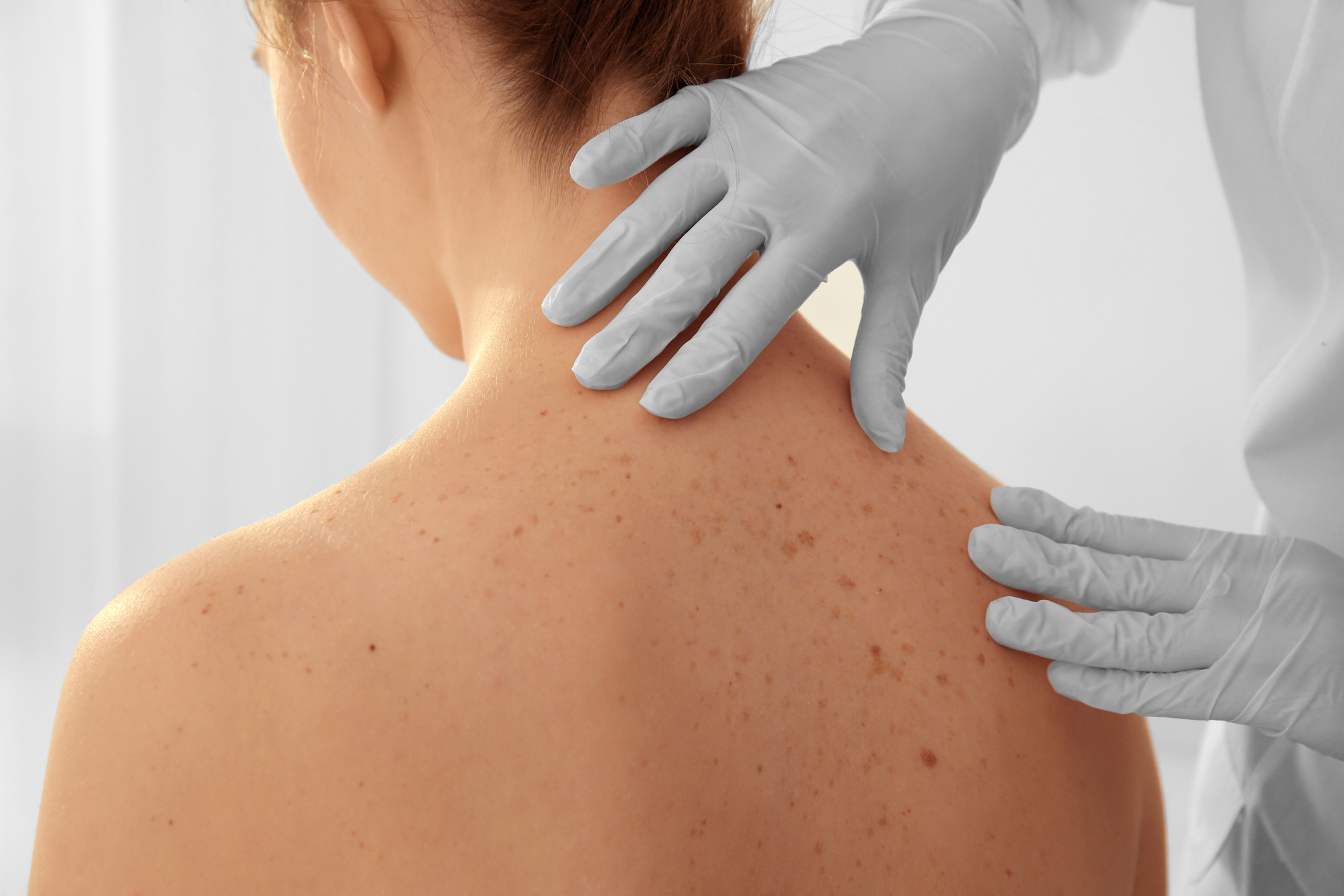 What to Expect During a Skin Cancer Screening