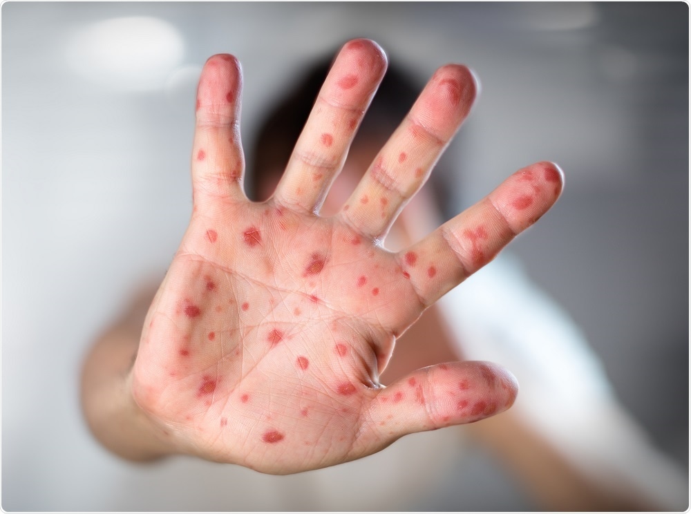 Measles Health Update