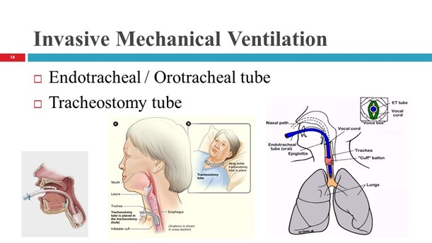 Invasive Mechanical Ventilation | Endotracheal/Orotracheal tube | Tracheostomy tube