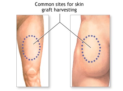 skin grafting sites | wickenburg community hospital surgical center