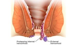 hemorrhoid illustration | internal and external