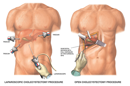 Laparoscopic cholecystectomy vs. open cholecystectomy