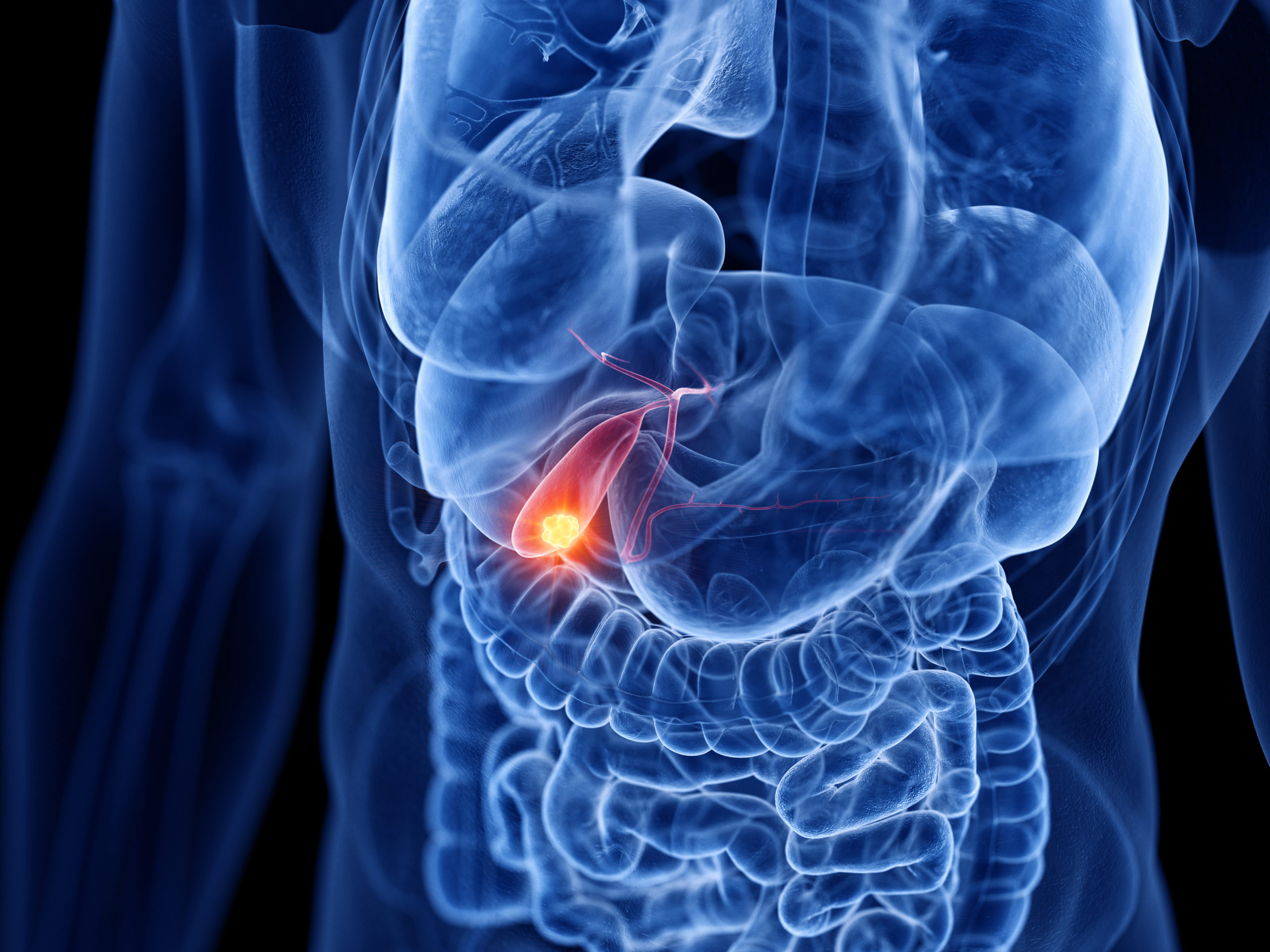 Understanding Gallbladder Disease
